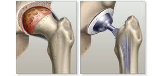 Hip replacement Balaghat