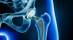 Hip replacement Chhindwara