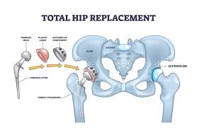 Hip replacement Gadchiroli