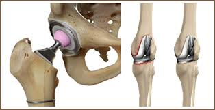 Hip replacement Harda
