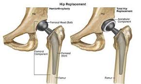 Hip replacement Hoshangabad