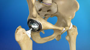 Hip replacement Hoshangabad