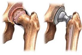 Joint Replacement Low Cost In Hoshangabad