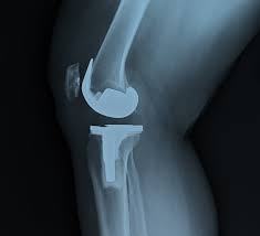 Joint Replacement Low Cost In Chandrapur