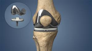 Joint Replacement Low Cost In Chhindwara