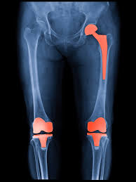 Joint Replacement Low Cost In Gondia