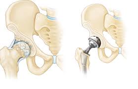 Joint Replacement Low Cost In Harda