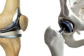 Joint Replacement Low Cost In Katni