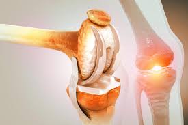 Joint Replacement Low Cost In Sagar