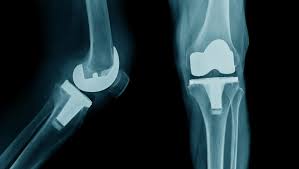 Joint Replacement Low Cost In Balaghat