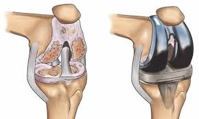 Joint Replacement Low Cost In Yavatmal