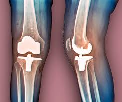 Joint Replacement Low Cost In Yavatmal