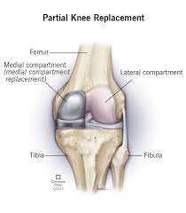 Knee replacement Shahdol