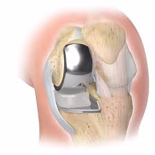 Knee replacement Harda