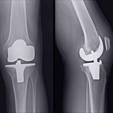 Knee replacement Mandla