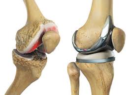 Knee replacement Sagar