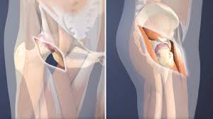 Minimally Invasive Hip Surgery In Bhandara