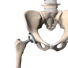 Minimally Invasive Hip Surgery In Gadchiroli