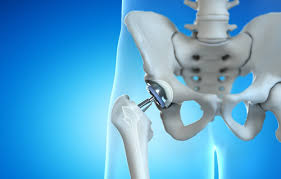 Minimally Invasive Hip Surgery In Gondia
