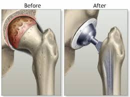 Minimally Invasive Hip Surgery In Harda