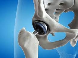 Minimally Invasive Hip Surgery In Hoshangabad