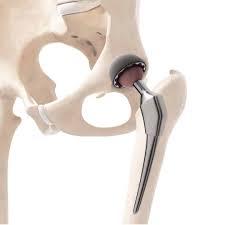 Minimally Invasive Hip Surgery In Hoshangabad