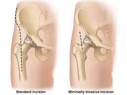 Minimally Invasive Hip Surgery In Katni