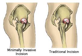 Minimally Invasive Hip Surgery In Seoni