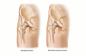 Minimally Invasive Hip Surgery In Yavatmal