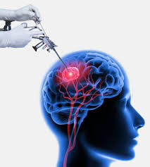 Neuro Surgery in Bhandara
