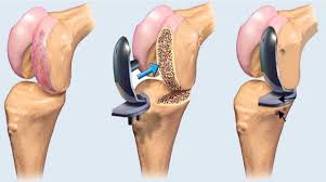 PMJAY Hospital List For Joint Replacement In Sagar