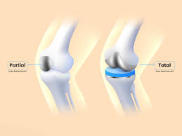 Partial Knee Replacement in Betul