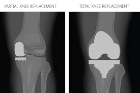 Partial Knee Replacement in Betul