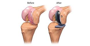 Partial Knee Replacement in Rewa