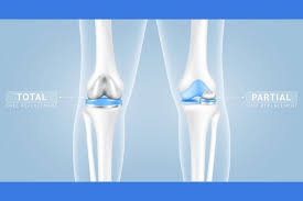 Partial Knee Replacement in Rewa