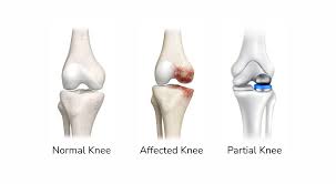 Partial Knee Replacement in Seoni