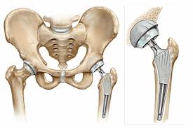 Precision Hip Replacement In Amravati