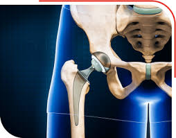 Precision Hip Replacement In Bhandara