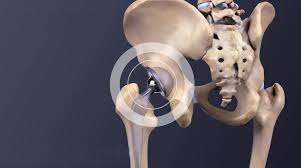 Precision Hip Replacement In Chandrapur