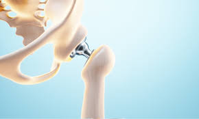 Precision Hip Replacement In Gadchiroli