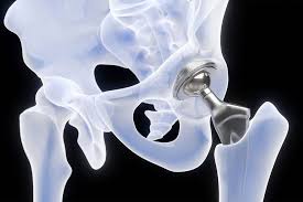 Precision Hip Replacement In Gondia