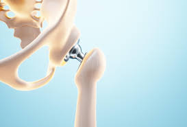 Precision Hip Replacement In Betul