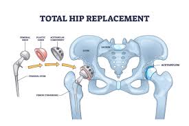 Precision Hip Replacement In Jabalpur