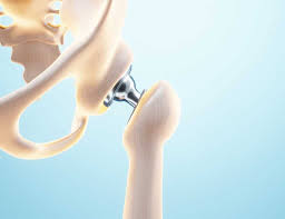 Precision Hip Replacement In Katni