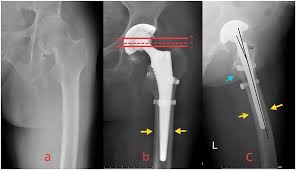 Precision Hip Replacement In Mandla