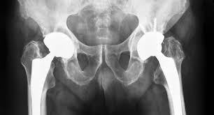 Precision Hip Replacement In Sagar