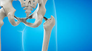 Quick Recovery Hip Surgery In Amravati