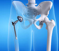 Quick Recovery Hip Surgery In Balaghat