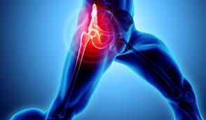 Quick Recovery Hip Surgery In Hoshangabad