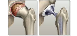 Quick Recovery Hip Surgery In Bhandara